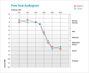 Cara Membaca Audiogram serta Pengertian Audiogram