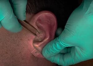 Manfaat penggunaan ear seeds terapi akupuntur untuk telinga
