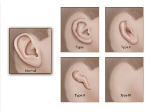 mikrotia. Sumber: Stanford Medicine