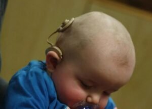 operasi implan koklea